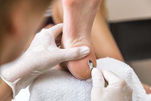 Treating skin on heel of foot